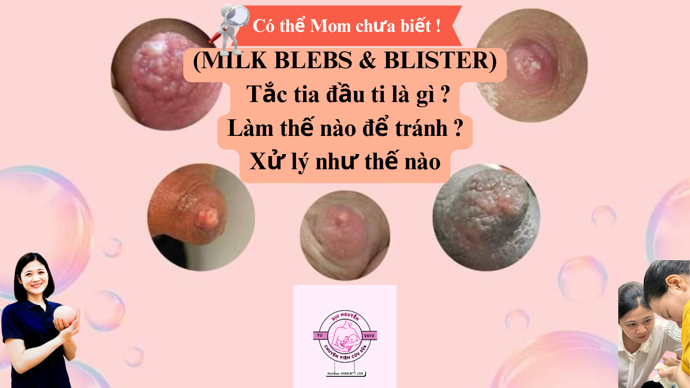 Tắc tia sữa đầu ti